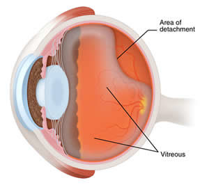 Eye Flashes and Floaters - Eye Floaters Treatment Washington DC - Posterior Vitreous Detachment