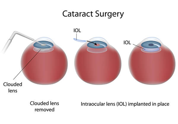 Cataract Treatment Washington DC - Cataract Surgery 