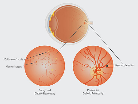 Diabetic Retinopathy Treatment Washington DC - Diabetic Eye Doctor