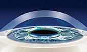 Visian Implantable Collamer Lens DC - Permanent Contact Lenses - Best ICL Surgeons