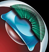 ICL Eye Surgery Washington DC - Implantable Contact Lenses - ICL Surgeons Maryland