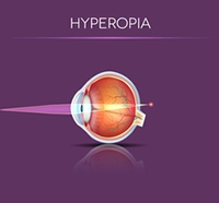 Hyperopia laser eye surgery - Can LASIK fix farsightedness?
