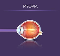 Can LASIK fix Myopia - laser eye surgery for nearsightedness