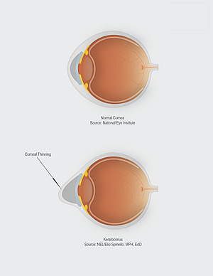 Keratoconus Doctor Washington DC - Keratoconus Specialists