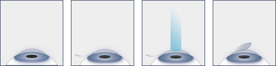 LASIK Surgery Washington DC - Laser Eye Surgery