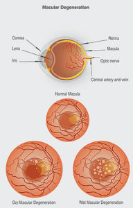 Macular Degeneration Treatment Washington DC - Macular Degeneration Specialists Near Me