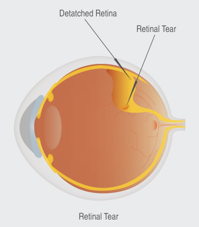 Retinal Tear vs. Retinal Detachment - Monterey, CA - Salinas