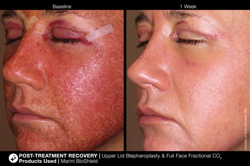Before and After Jan Marini Skin Research Skincare Products