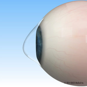 intacs use by keratoconus doctors