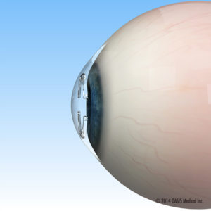 Intacs used by keratoconus specialists in Chevy Chase Maryland