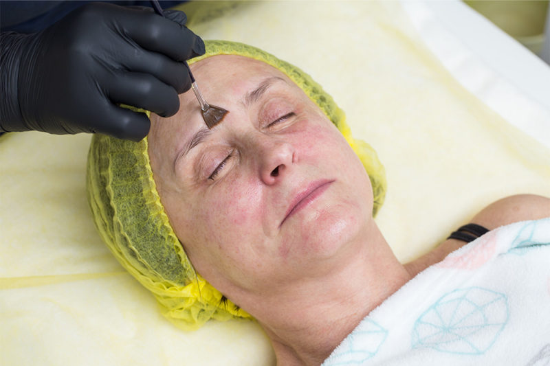 Chemical Peel DC – The Perfect Derma Peel - Non Invasive Cosmetic Procedures